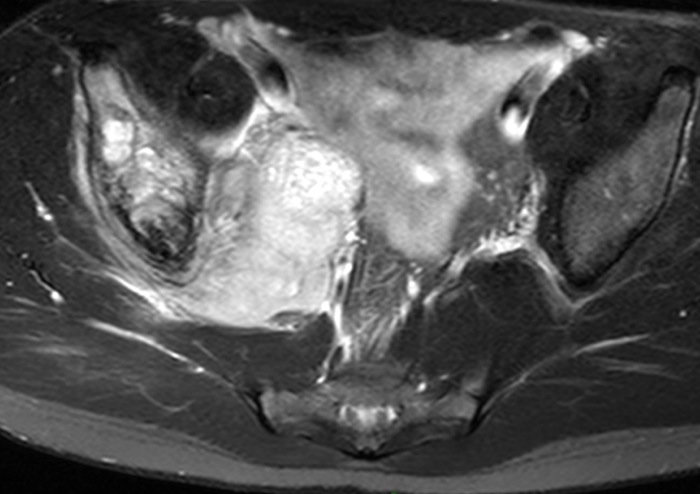 Figure 4 for case Ewing sarcoma ( RID4522 )